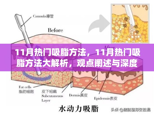 深度解析,11月热门吸脂方法及其观点阐述与探讨